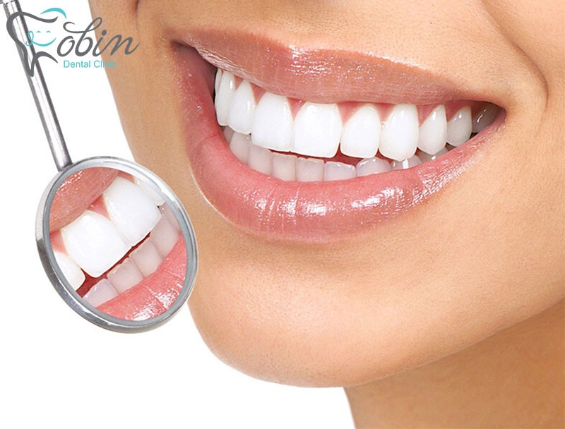 در مورد لمینت دندان چه می دانید؟